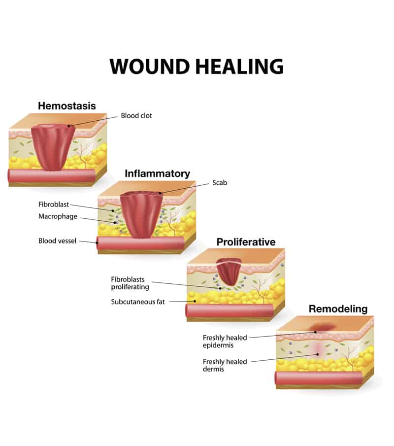 Le fasi del processo di guarigione di una ferita.