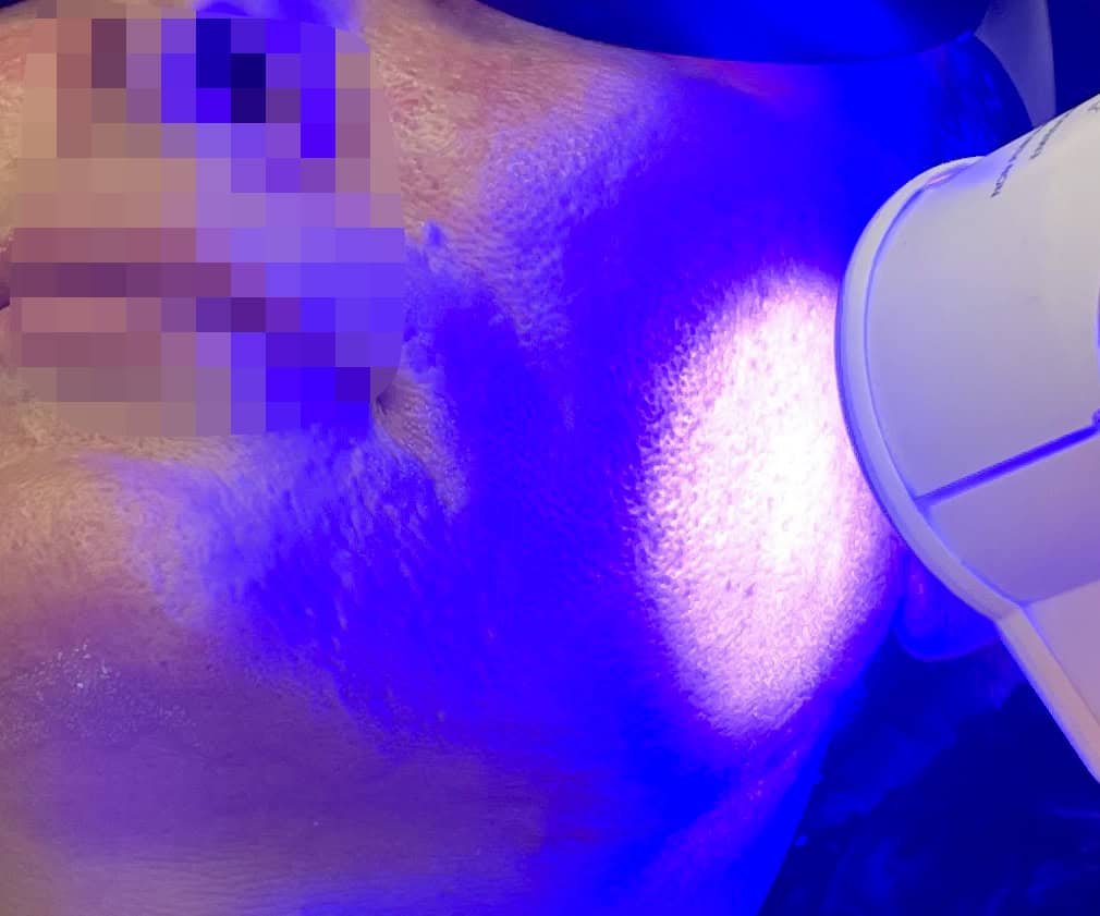 La Luce Blu in medicina estetica