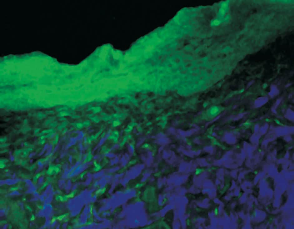 La Luce Blu nel trattamento dei cheloidi